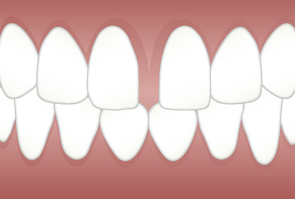 Diastema (Diş Aralıkları) Nedir?  